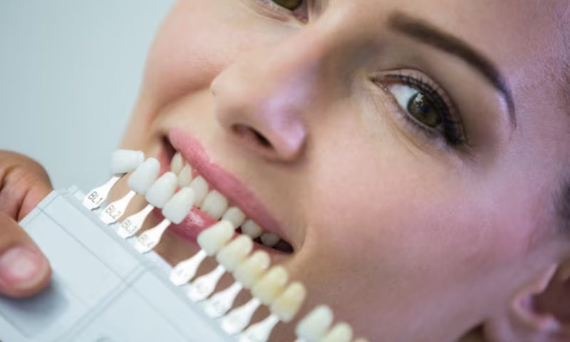veneers in tucson