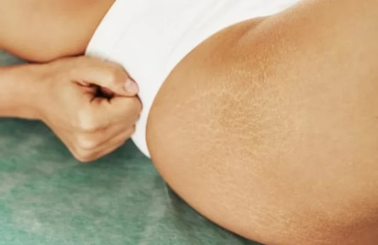 Stretch Mark Microneedling
