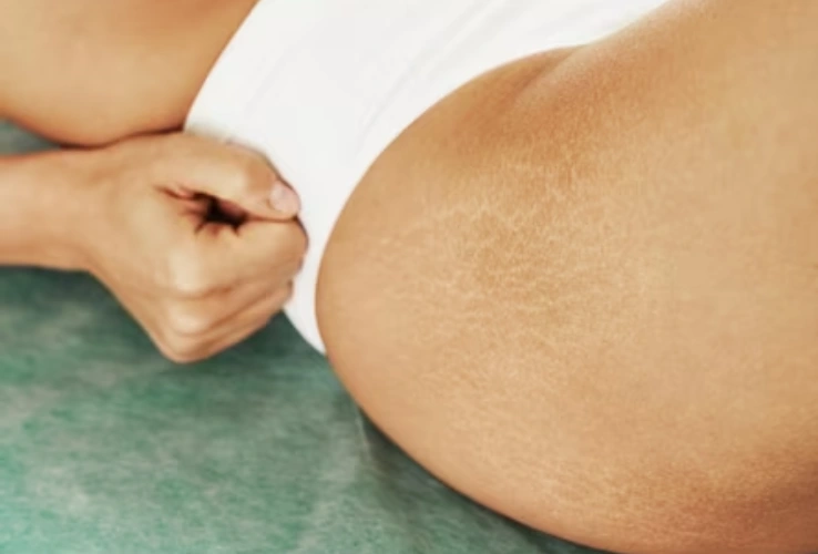 Stretch Mark Microneedling