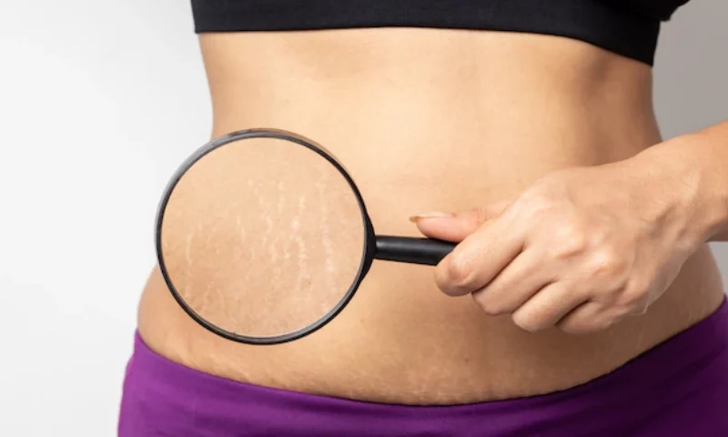 stretch mark microneedling