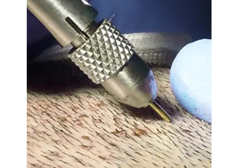 Hair Transplant in Turkey