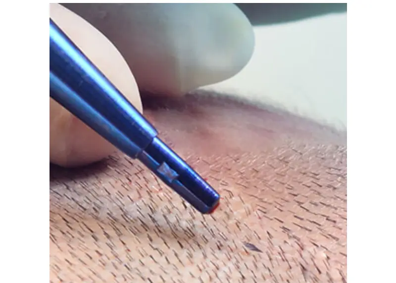 Hair Transplant in Turkey